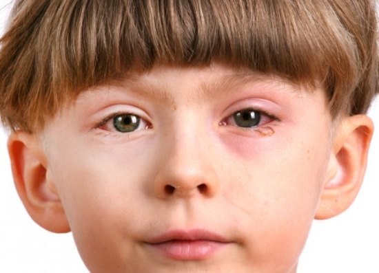 4c83f5c790b92065a986d52d23bf4e86 Конюнктивіт очей — симптоми, ознаки і прояви у дорослих