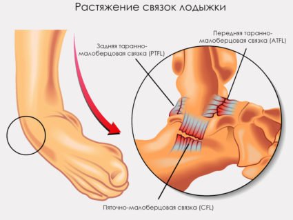 50813b794b3c99c720f6d6d95de67a5f Розрив звязок на нозі: симптоми, лікування, скільки гоїться