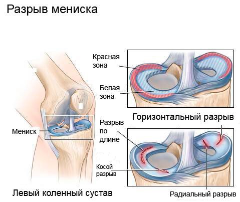 554664cbf5319400b72a4ee7f73d01a2 Розрив меніска колінного суглоба: лікування без операції, симптоми