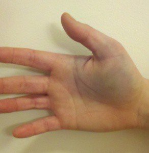 5b435c576ea499ea5ac4c8c72c3b8a84 Перелом пальця на руці: ознаки і симптоми, скільки носити гіпс