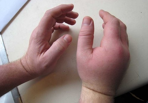 745ef9ea400d337e84489eb73dd6ce87 Забій кисті руки при падінні і ударі: лікування, симптоми