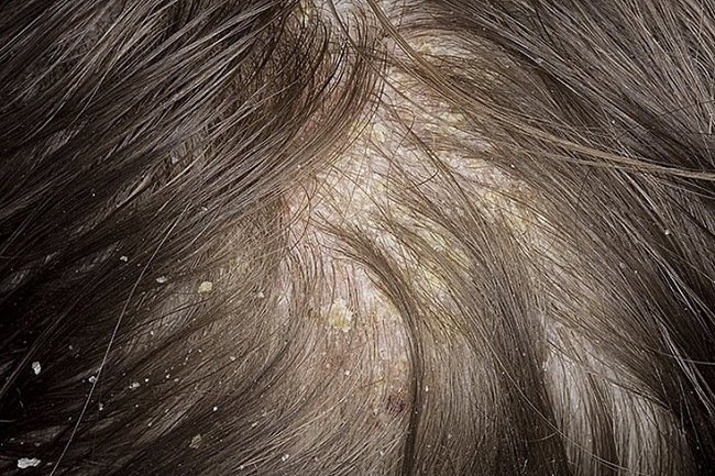 77183b876cf9ac6e41ef64af8124796a Протигрибковий шампунь для волосся: ТОП 6 шампунів від грибка (відгуки)