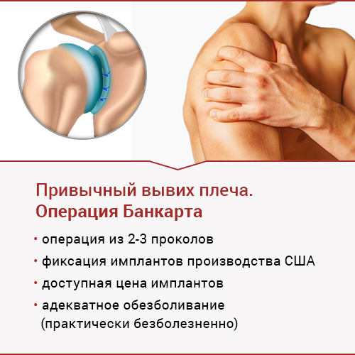84b0dea72c0eecb7b82899cc1b850619 Звичний вивих плеча: лікування (з операцією і без)