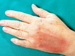 91d6a186cac120fcc820cbc484824d56 Забій кисті руки при падінні і ударі: лікування, симптоми