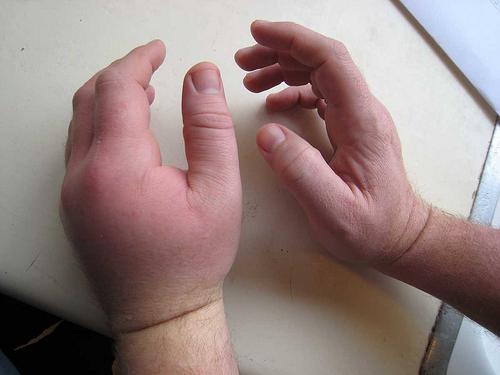 92943455a9d7c7b9fcc8fecab669eadd Перелом руки: ознаки, симптоми, скільки носити гіпс