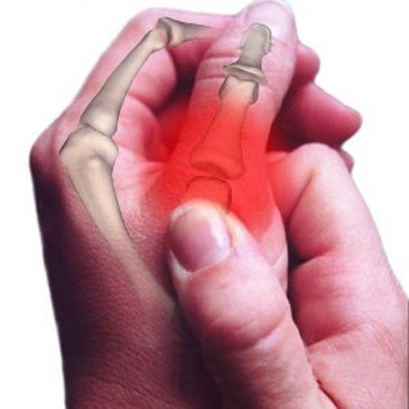 9ff1449fe29b9dbd3d6aa3d2e356d3d7 Перелом пальця на руці: ознаки і симптоми, скільки носити гіпс