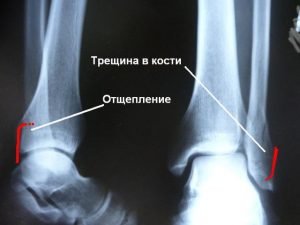 a11a63ffcdc70673bb564d9c2a4dd45b Тріщина в кістки на нозі і руці: симптоми, лікування