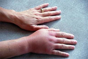 a79f9d64849a014c73ff35fcaf4501df Перелом кисті руки: симптоми і лікування, скільки днів носити гіпс