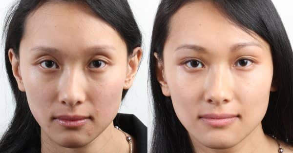 b01dba1e20cf877280c95e8067ab831d Корекція форми обличчя філерами у вилиці: особливості, фото до і після