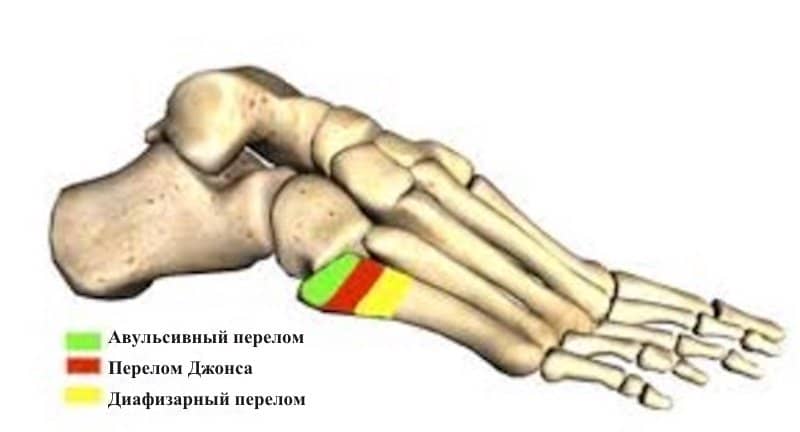 b1441d6086575a3bc4e9846d702596ea Перелом плеснової кістки стопи: скільки ходити в гіпсі, реабілітація