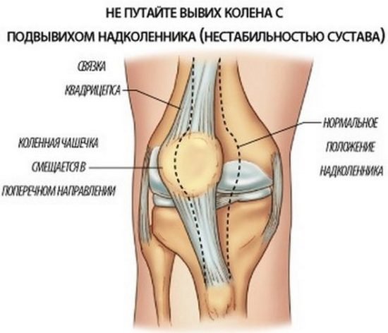 c1c6dc9068e675ec8872d28e42d08ade Вивих надколінка (колінної чашечки): симптоми, лікування, реабілітація