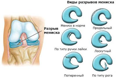 cd6449a1b5f5eeb5e80085442cad60bb Розрив меніска колінного суглоба: лікування без операції, симптоми