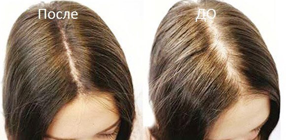 cf0d70c3adc3c491ac77e7790fa2b452 Апарат Дарсонваль для волосся: для росту волосся і від випадіння