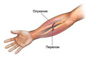 d1b15dd66a6fa9b2a5eaf93752adf9e2 Перелом руки: ознаки, симптоми, скільки носити гіпс