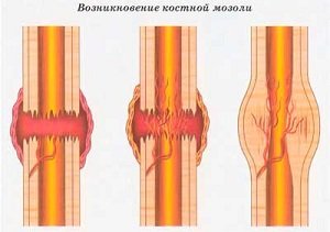 d385c3386632e0f3bc671e15e36d8a99 Перелом мізинця на нозі: симптоми, що робити, як швидко вилікувати