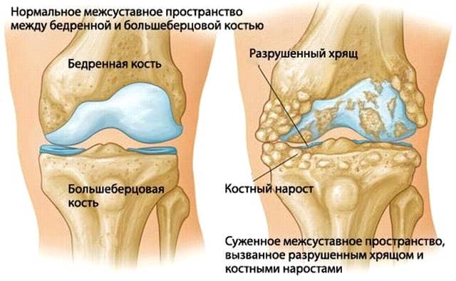 d610ee10528023f9219e9bb49fa2c849 Лікування артрозу колінного суглоба медикаментозно. Препарати, креми, мазі, інєкції, компреси