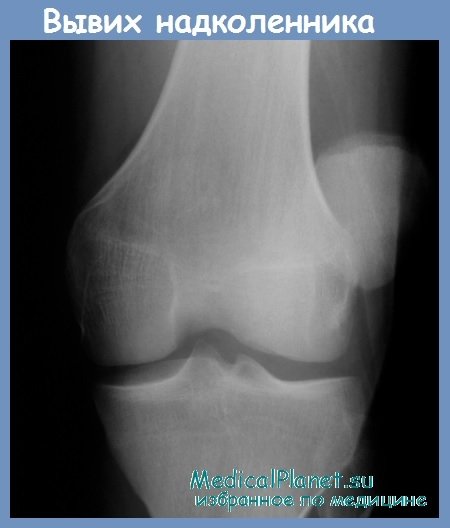 ee5013e13d65573730587f7ee8cc4977 Вивих надколінка (колінної чашечки): симптоми, лікування, реабілітація