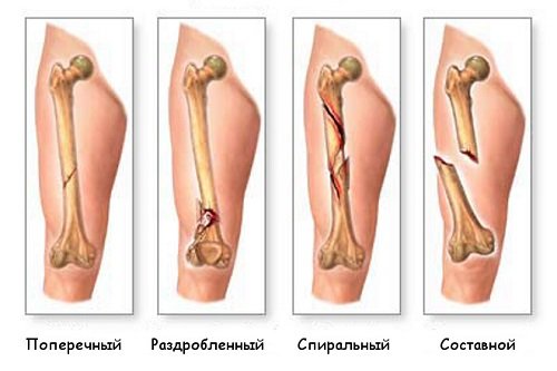 efd01110a6e39ec6c4c06088cf3255eb Тріщина в кістки на нозі і руці: симптоми, лікування