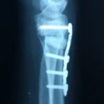 f4007fa23e006603e1ba37b03a8db00a Перелом променевої кістки: скільки носити гіпс, лікування, термін зрощення