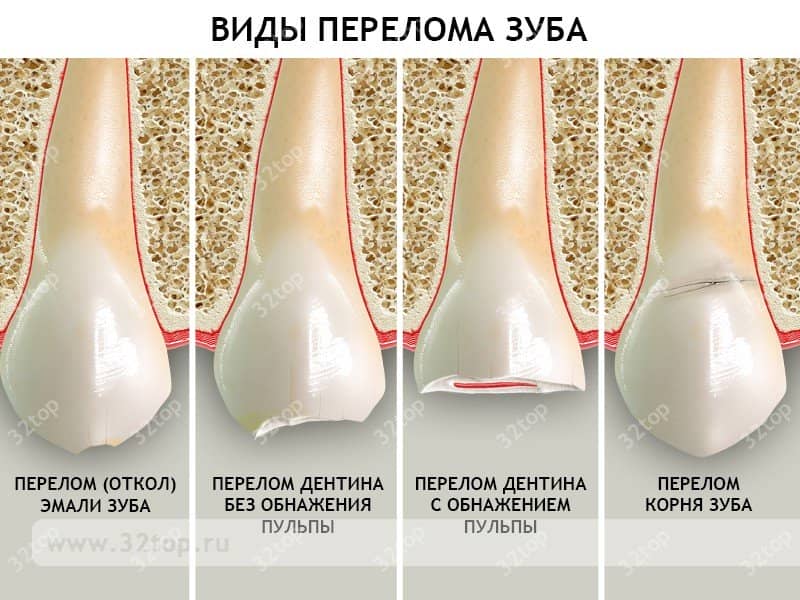 fe86f40ce5bc3b9e8b1b4c1cb324b55e Перелом зуба (кореня): ознаки, відновлення