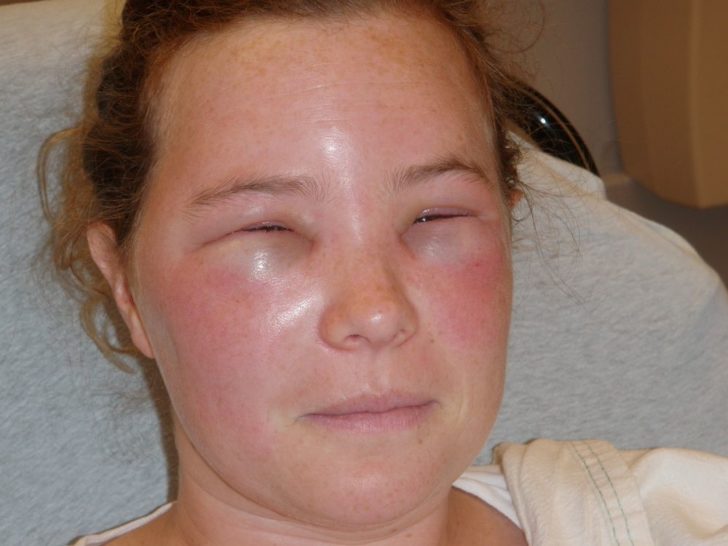 00631845820b9980db12b99f00b8a0e6 Набряк Квінке (код за МКХ 10 T78.3): симптоми і лікування, перша допомога при алергічному набряку