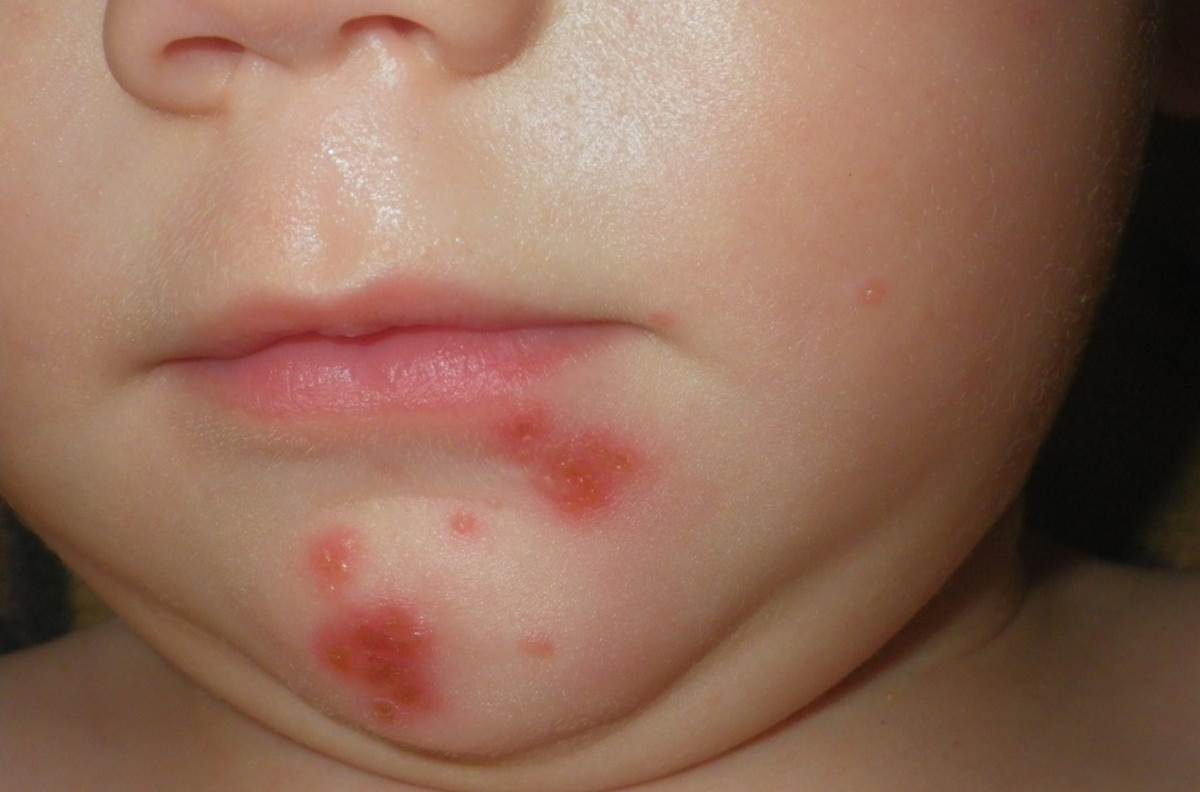 023f1408d5ad3dbc1692dfc57ad6e578 Герпес в роті у дитини: як лікувати, чим лікувати, симптоми вірусу, аналізи для діагностики, фото