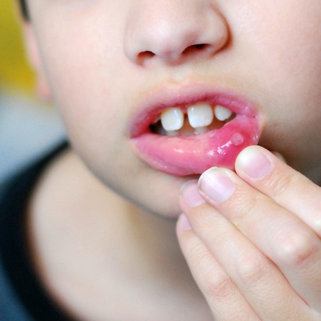 710a0e9a795905ccc5685485efa813f0 Герпес в роті у дитини: як лікувати, чим лікувати, симптоми вірусу, аналізи для діагностики, фото
