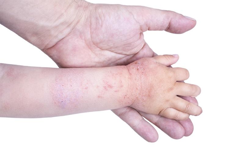 760b7726191292e63cad6196e698c3ba Харчова алергія у дитини 1 року: симптоми, як проявляється і виглядає на обличчі, лікування, дієта, профілактика