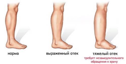 7f6de853efeeafd3a38b3401789794d2 Чому набрякають ноги в щиколотках у жінок: чим лікувати набряк і біль у нозі, причини, що робити