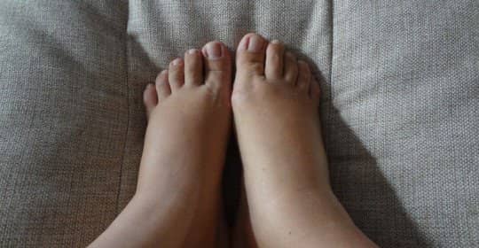 9dd5efb28a08b9693ea904d71f88c613 Чому набрякають ноги в щиколотках у жінок: чим лікувати набряк і біль у нозі, причини, що робити