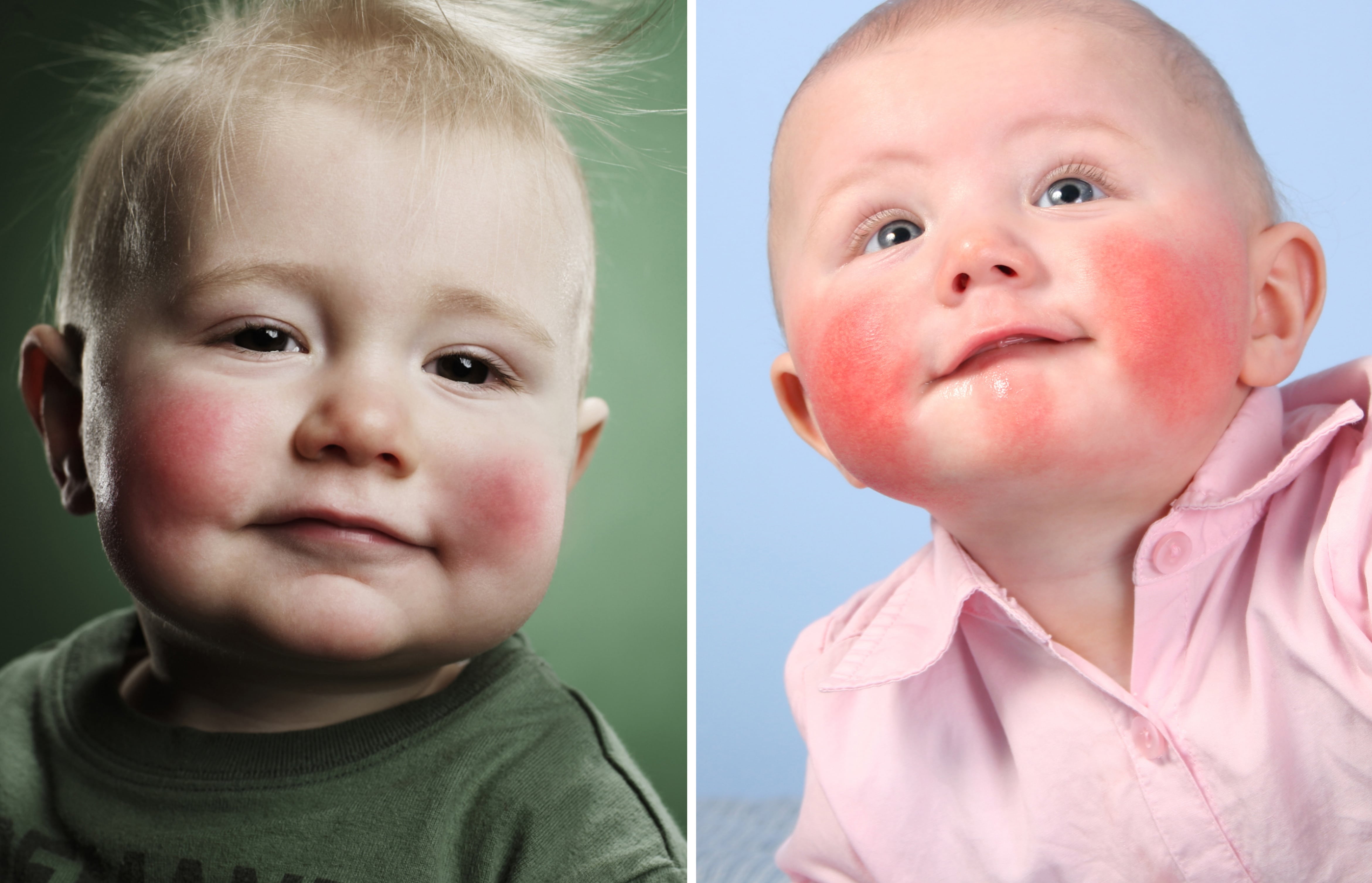 a03cba44085623928665f0f2f7fbafc7 Харчова алергія у дитини 1 року: симптоми, як проявляється і виглядає на обличчі, лікування, дієта, профілактика