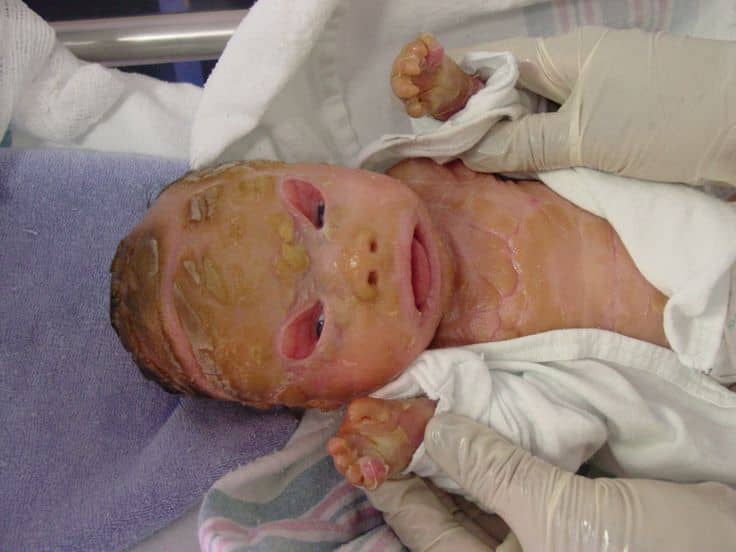 a8fe96af51f9aba5239257c735a9b403 У новонародженого лущиться шкіра: на тілі, голові, обличчі, руках, ногах — причини і що робити