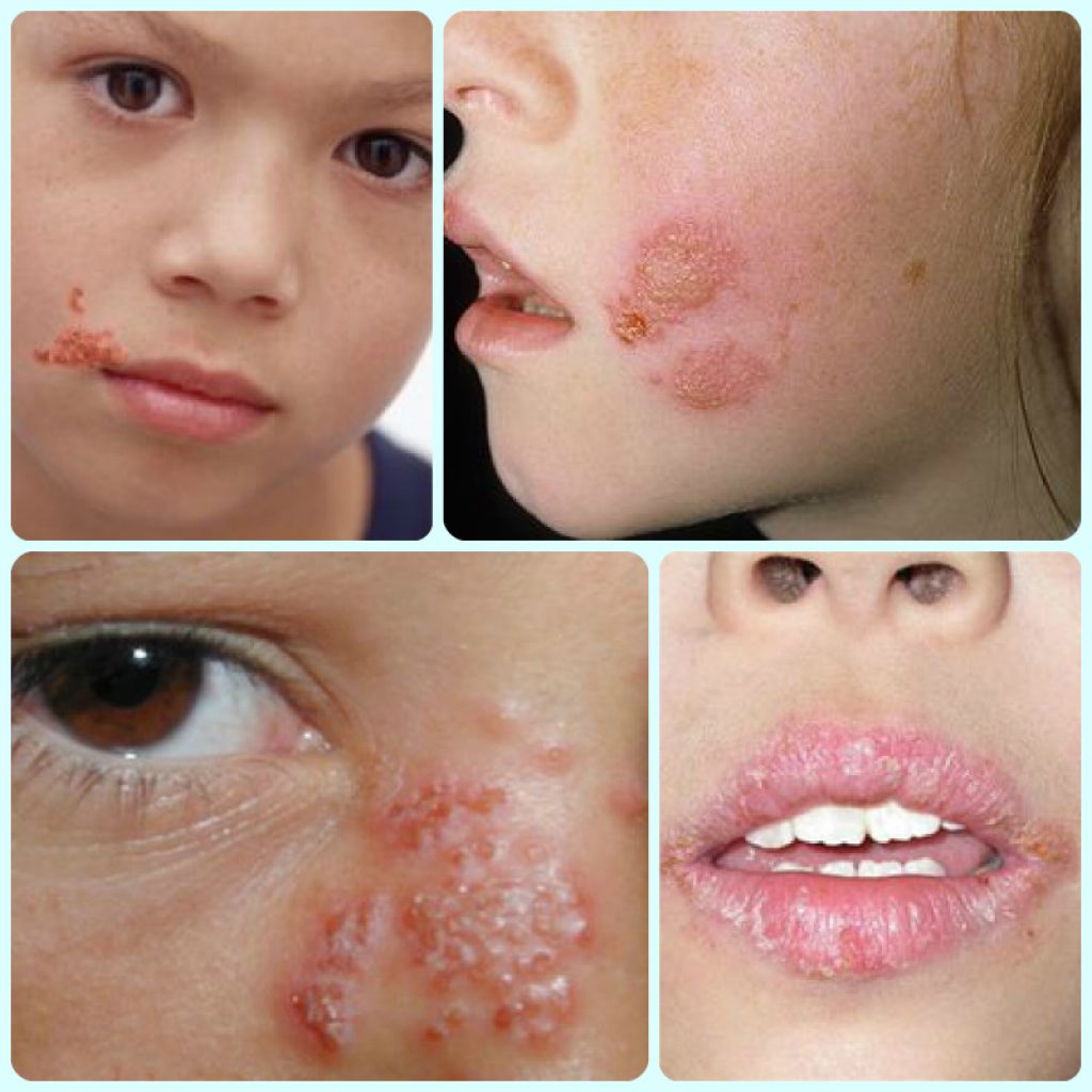 f0a6412442bf64569cad78ea2dd55243 Герпес в роті у дитини: як лікувати, чим лікувати, симптоми вірусу, аналізи для діагностики, фото