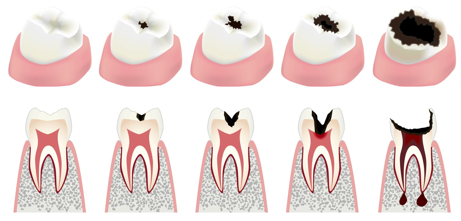 272db1583caa60bfa087da71e6fa7df6 Як очистити зуби від карієсу: домашніх умовах, як лікувати, етапи