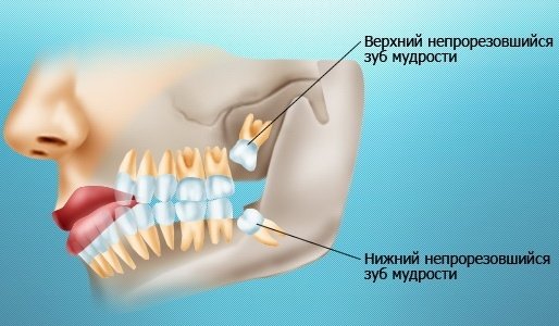7bd9c1df97e659401dfd6d05b7f14cbe Зуб мудрості: обовязково видаляти, характеристика зуба мудрості, показання до збереження і видалення, догляд після процедури видалення