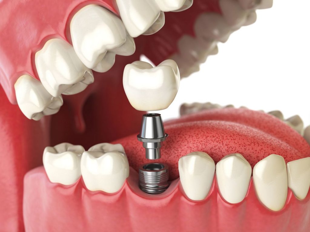 8ef3211e84e9399802f81c3edf6cd42f Які зуби краще вставляти пластмасові або керамічні: відмінність, ціна, характеристики