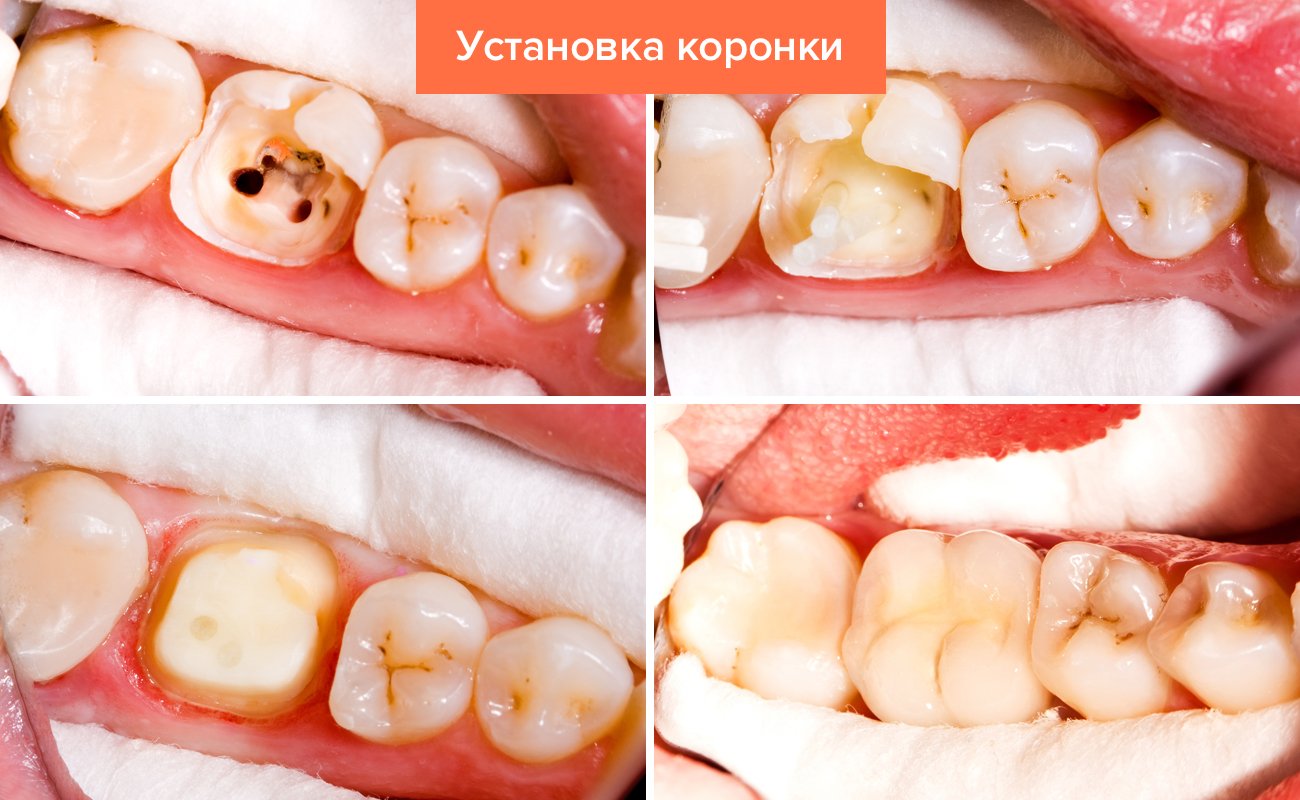 9802ff8f142070296868539848eaebd4 Які зуби краще вставляти пластмасові або керамічні: відмінність, ціна, характеристики