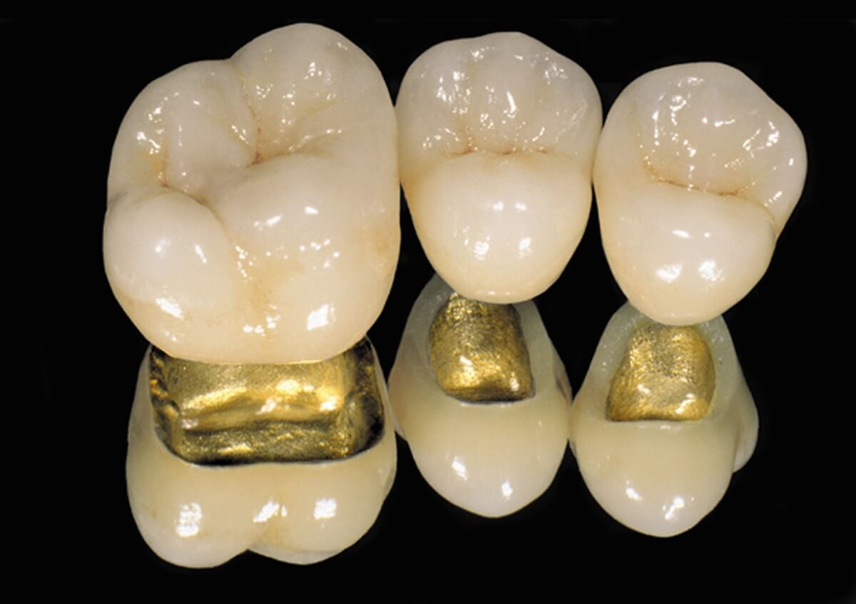 9a1710dd400435cc0f67c828583dedd4 Які зуби краще вставляти пластмасові або керамічні: відмінність, ціна, характеристики