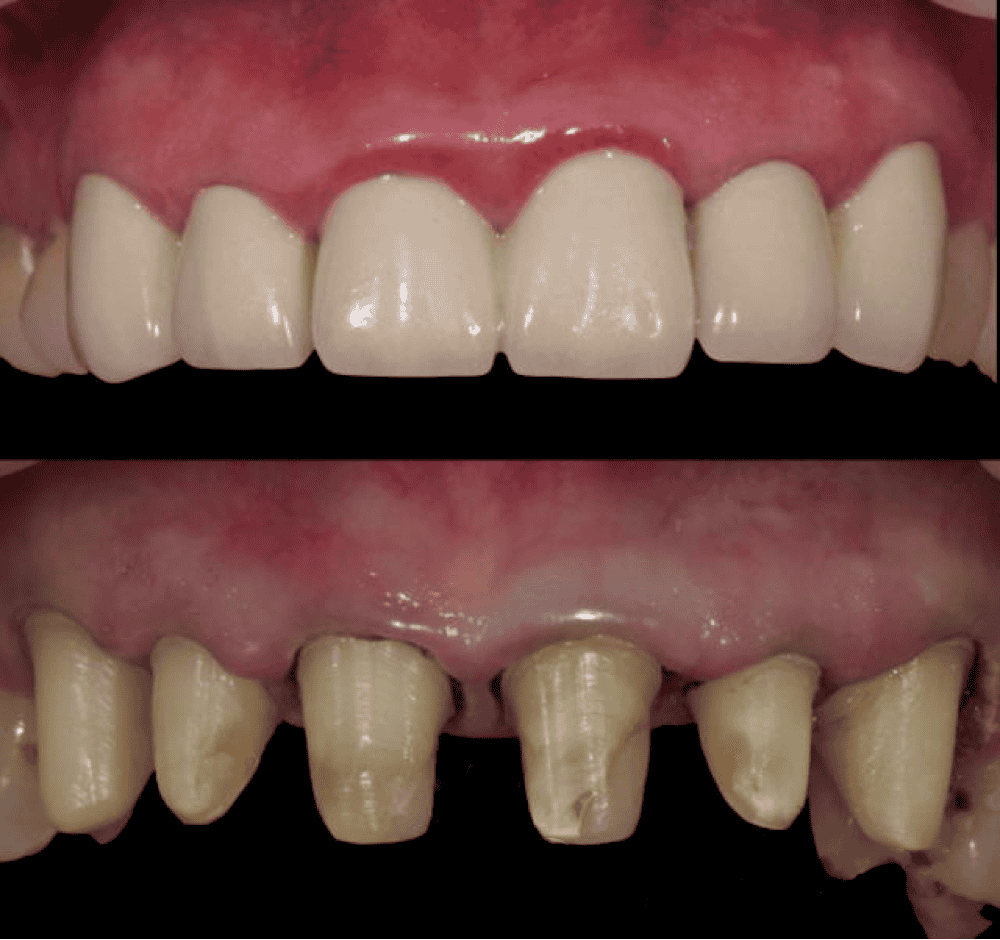 a7629e900c7eb9151cde8eac34f44f2b Які зуби краще вставляти пластмасові або керамічні: відмінність, ціна, характеристики