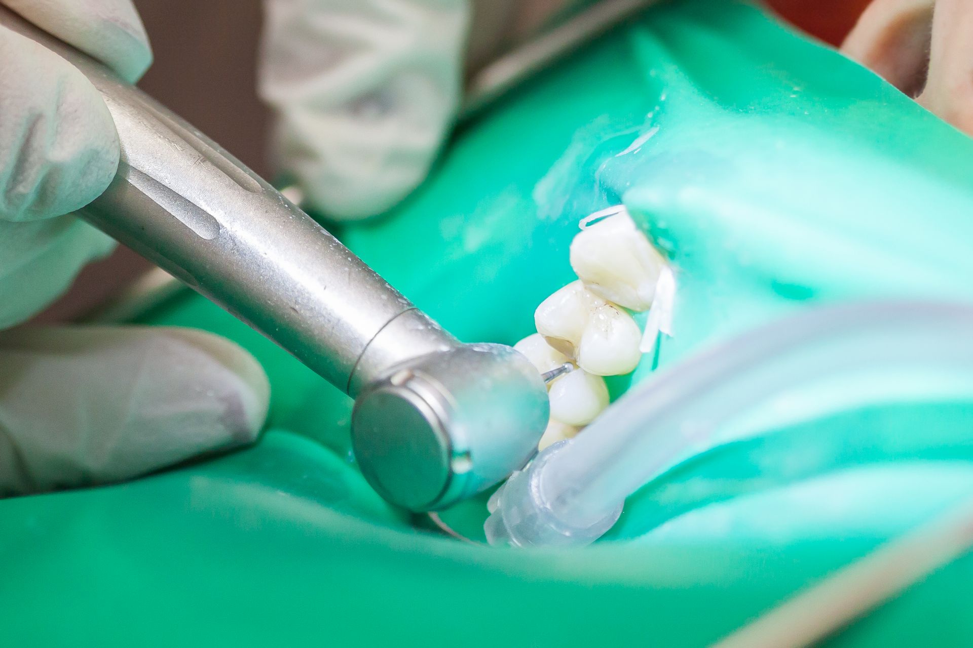 da4efaee54285e0c75daac1e0d439774 Як очистити зуби від карієсу: домашніх умовах, як лікувати, етапи