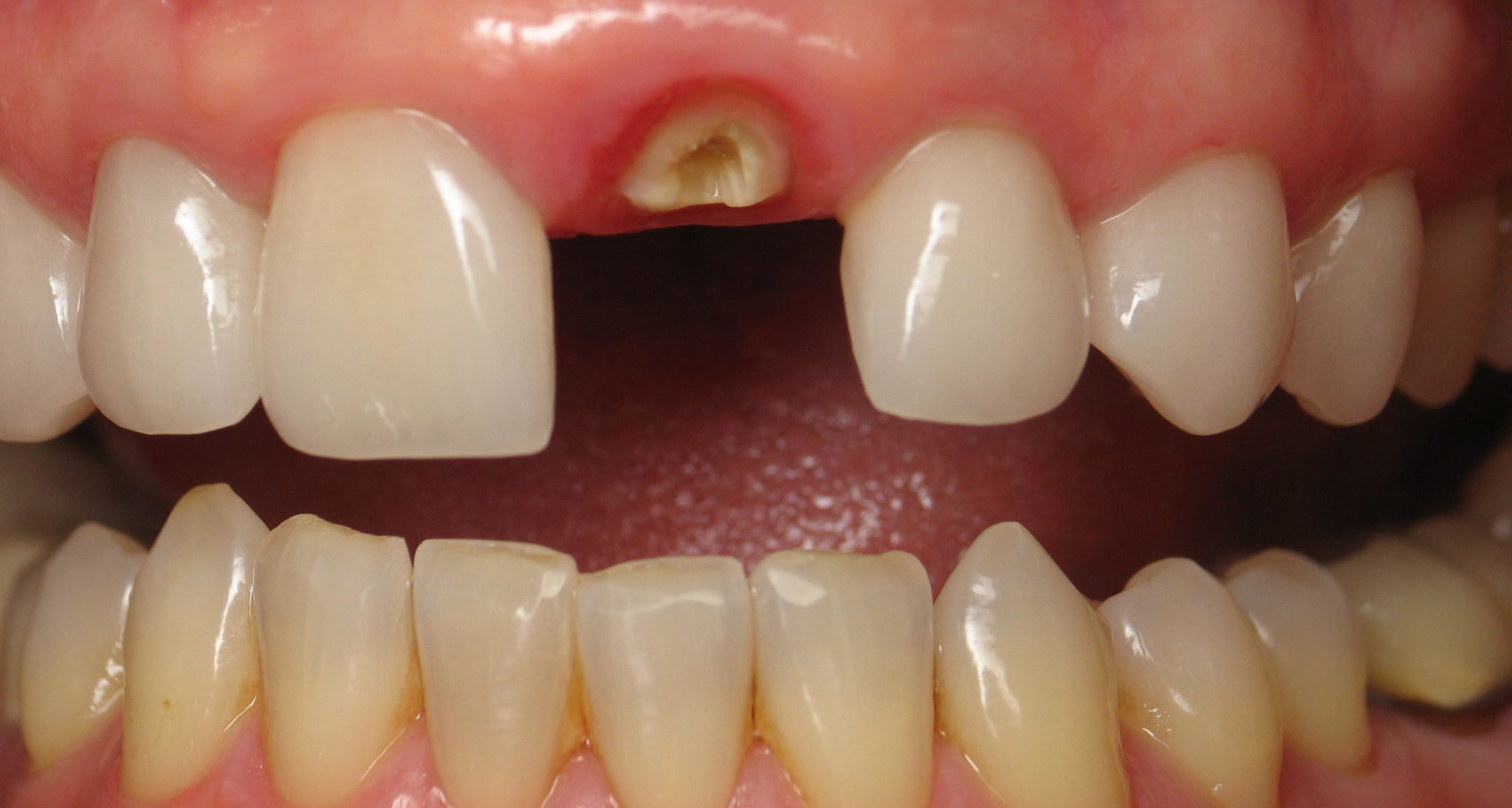dad85fe65dc9050fdc6fd2e3106e361c Які зуби краще вставляти пластмасові або керамічні: відмінність, ціна, характеристики