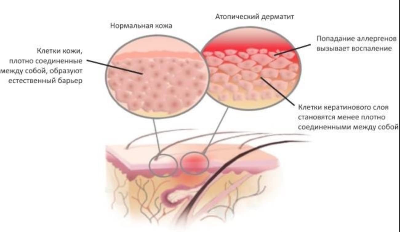 Атопический дерматит схема кожи