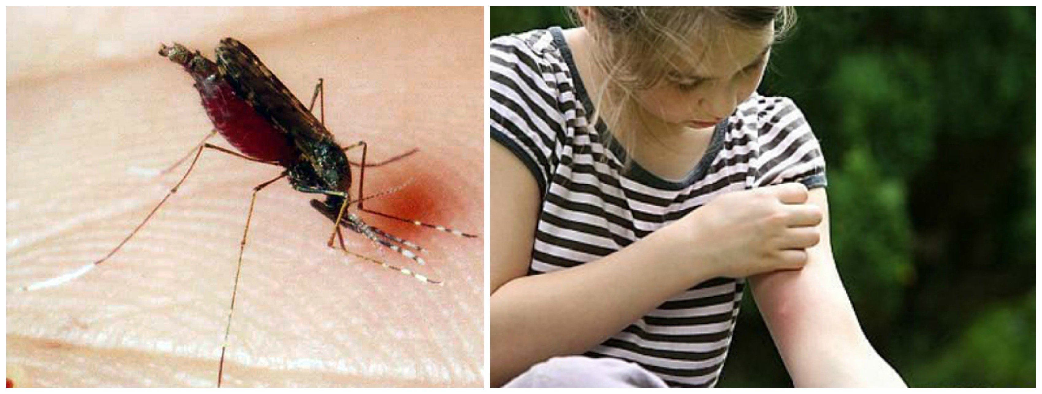 allergiya na ukusy komarov u detejj: lechenie, simptomy, foto, prichiny, silnaya allergiya u rebenka37 Алергія на укуси комарів у дітей: лікування, симптоми, фото, причини, сильна алергія у дитини