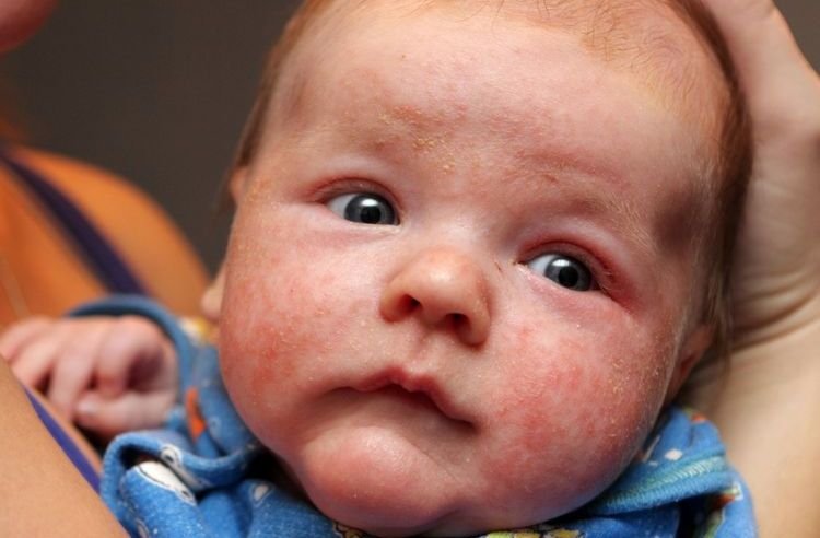 e75d88aa83ddfc1ef2d2fc3115536092 Як проявляється алергія на кішок у дітей | немовлят, новонароджених