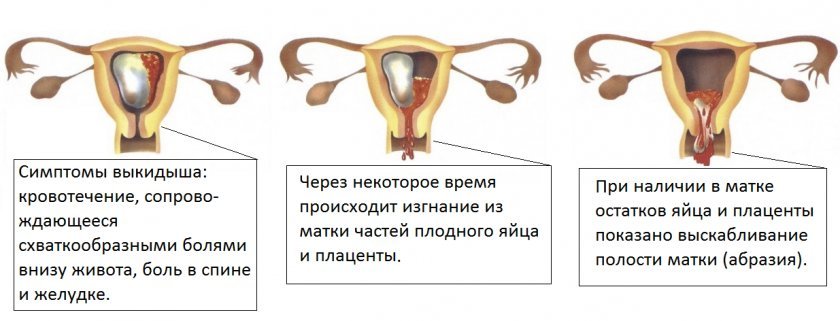 e442a242dbda810a72ba8ca27173d246 Петрушка для переривання вагітності на ранніх термінах: як це зробити, вплив петрушки на організм жінки