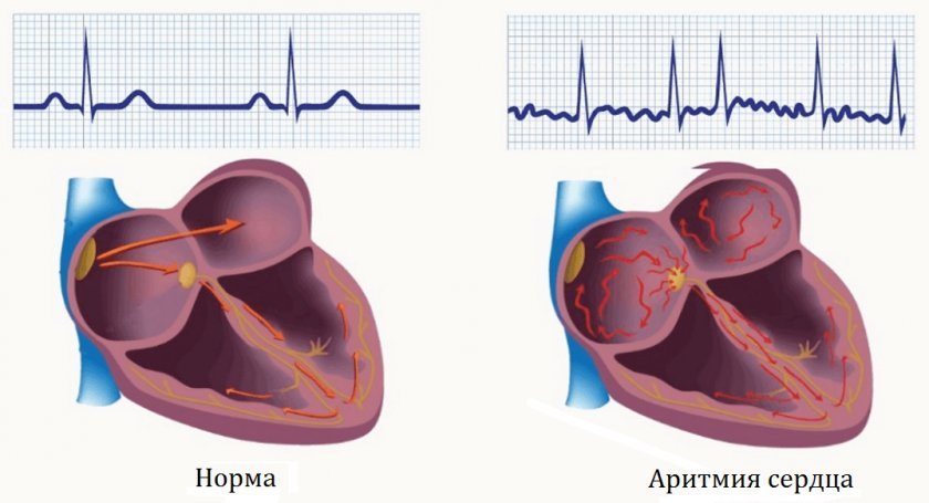 f5776148f910e2d331476eeb0c79d9d7 Імбир при хворобах серця: аритмії, тахікардії, вплив імбирного кореня на серцево судинну систему, рецепти народної медицини