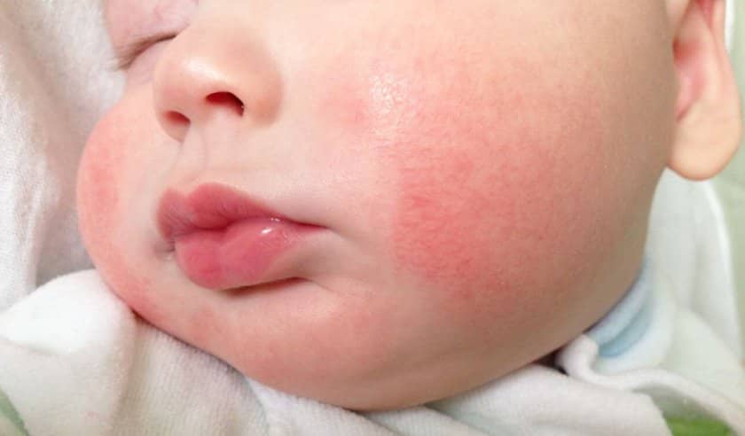 7d3431ca9d8a3976a9b8d61b924399bc Алергія на фундук: може виникати симптоми у дорослих і дітей, алергія на пилок